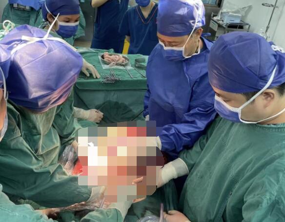 【南国早报】河池一男子肚大如临盆孕妇，医生从其腹中取出10公斤巨瘤