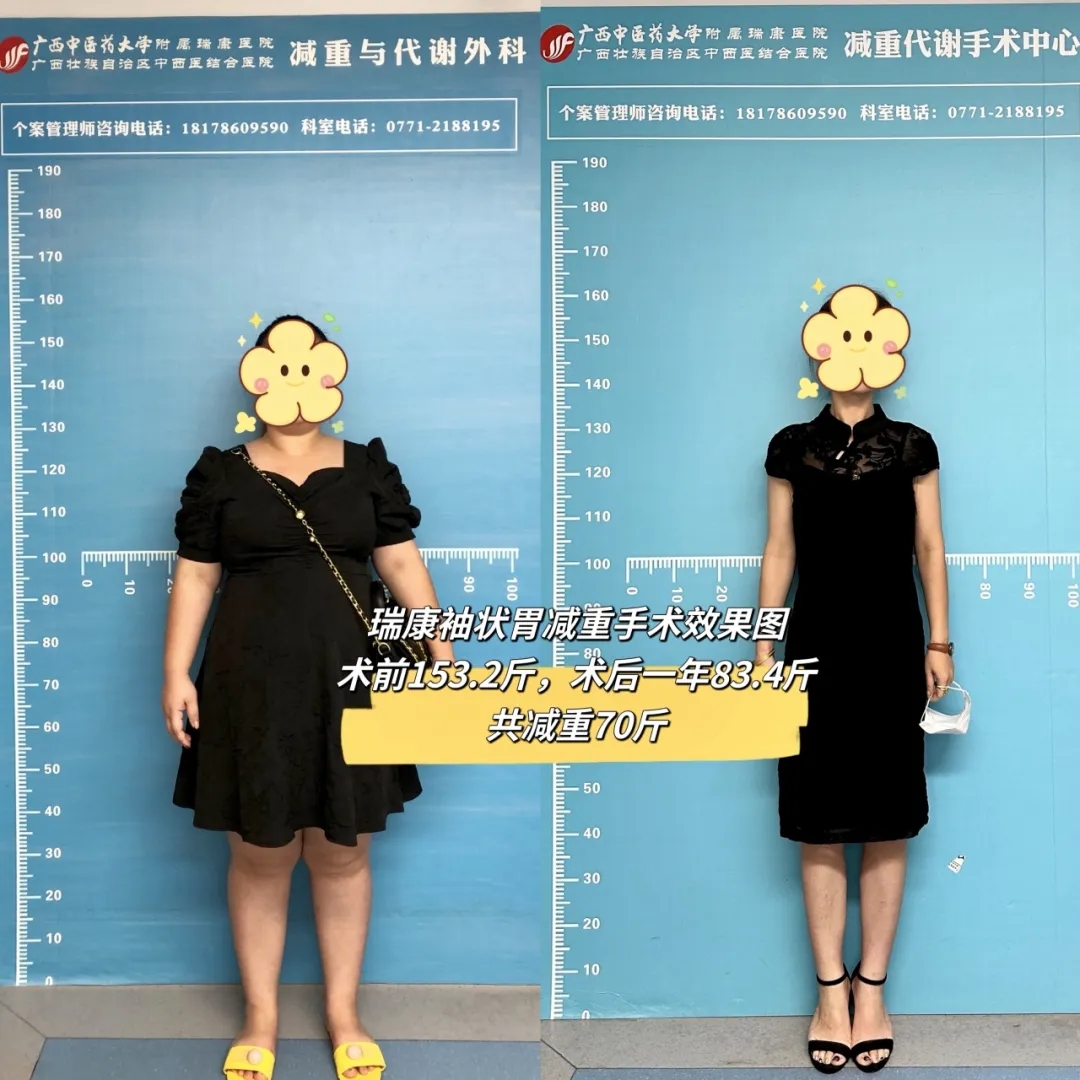 胖友们，减重手术费用减免优惠活动来啦！速速戳进来报名吧~